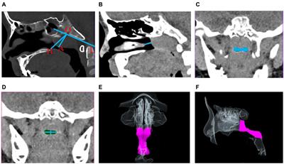 Diagnostic value of upper airway morphological data based on CT volume scanning combined with clinical indexes in children with obstructive sleep apnea syndrome